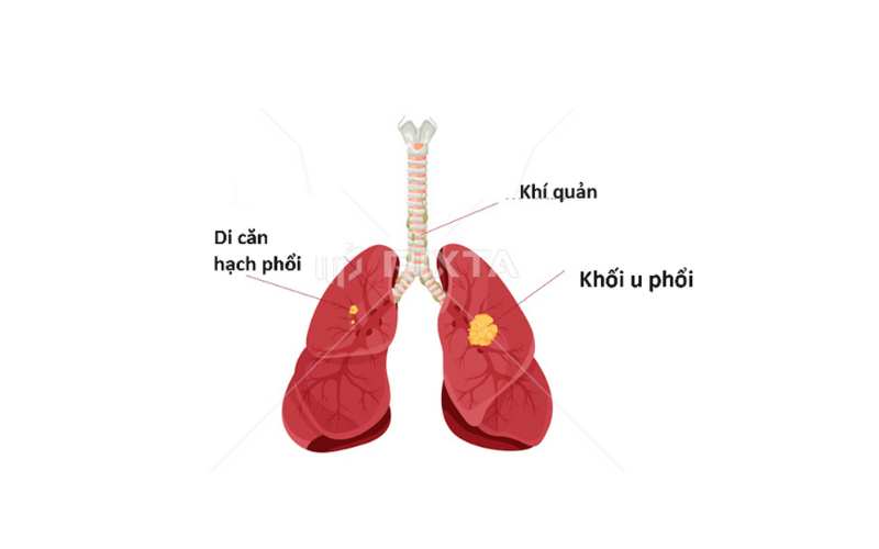 Ung thư phổi là gì? Nguyên nhân bắt nguồn từ đâu?